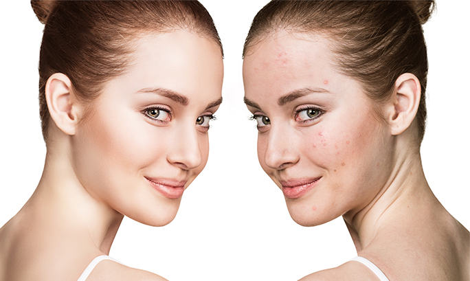 Sufres los efectos del acné adulto? | Oriflame Cosmetics